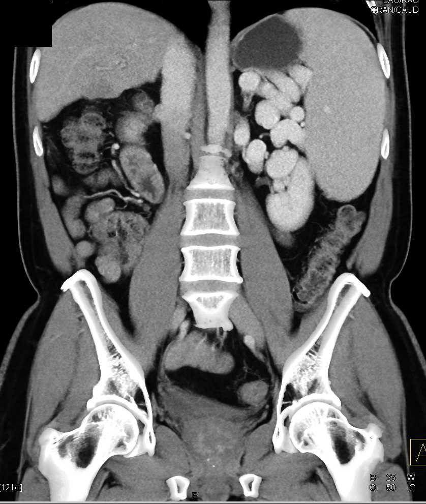 Cirrhosis with Splenomegaly and Large Varices - CTisus CT Scan