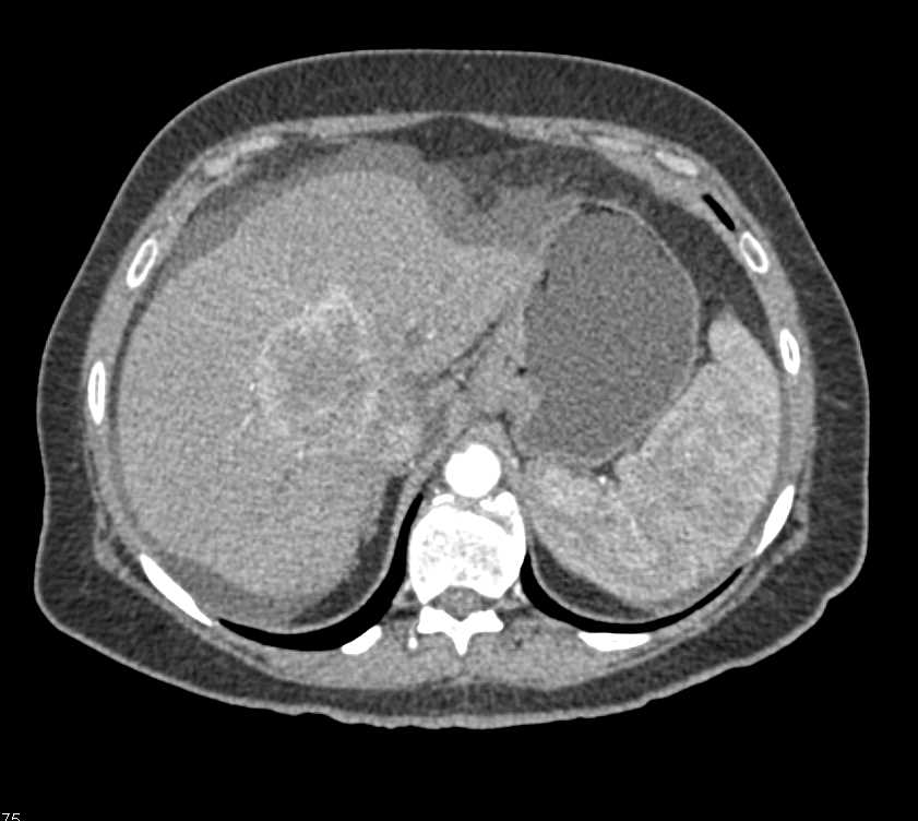 Hepatocellular Carcinoma (Hepatoma) - CTisus CT Scan