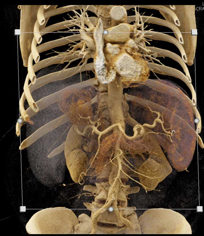 Hepatocellular Carcinoma (Hepatoma) - CTisus CT Scan