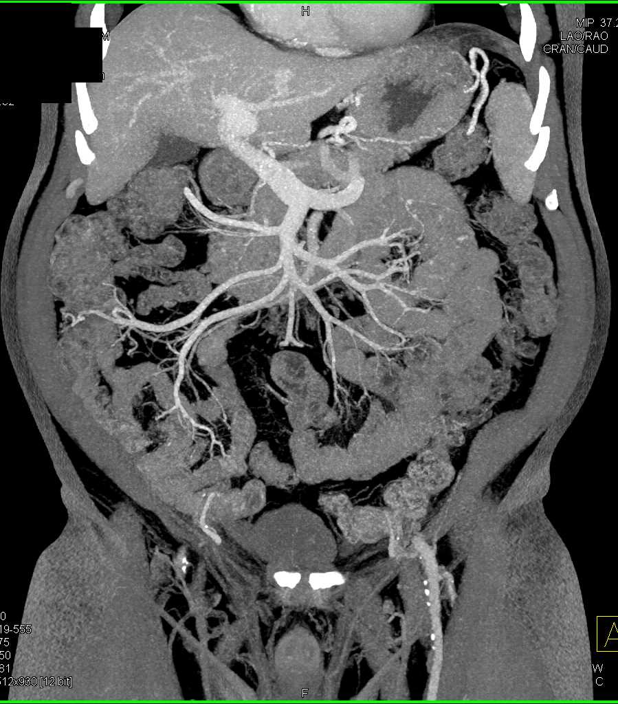 Portal Vein Aneurysm - CTisus CT Scan