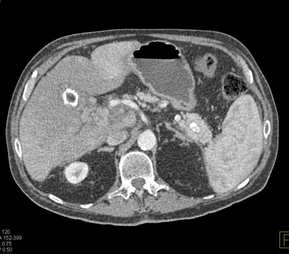 Hepatocellular Carcinoma (Hepatoma) - CTisus CT Scan