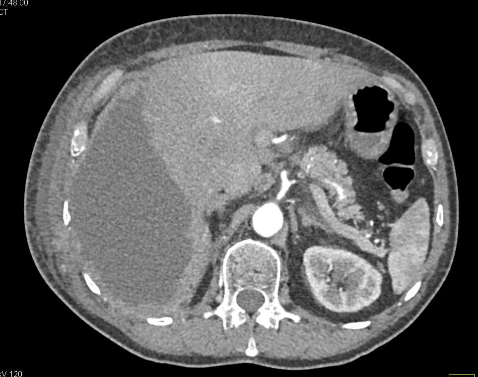 Subcapsular Bleed with Tumor Implants - CTisus CT Scan