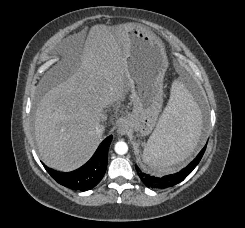 Cirrhosis - CTisus CT Scan