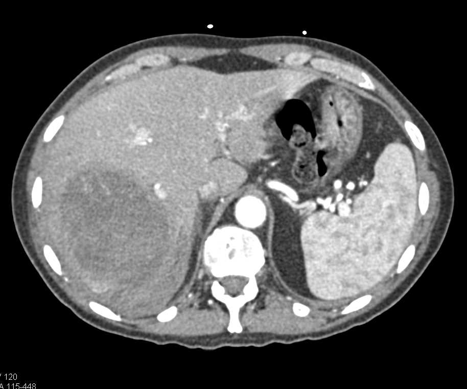 Metastatic Colon Cancer to Liver with Bleed - CTisus CT Scan