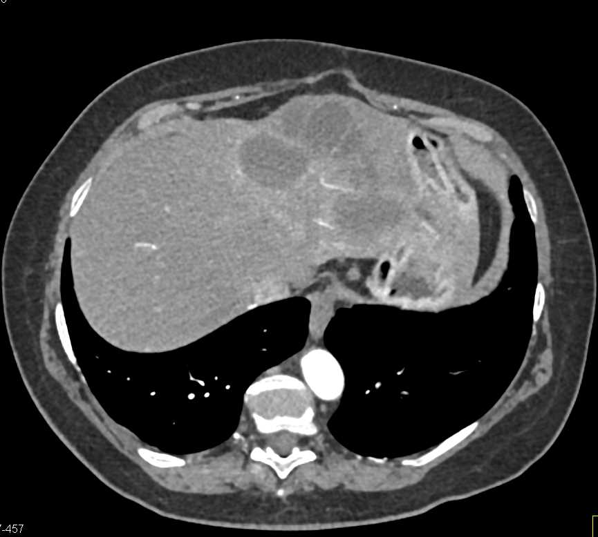 Cystic Cholangiocarcinoma - CTisus CT Scan