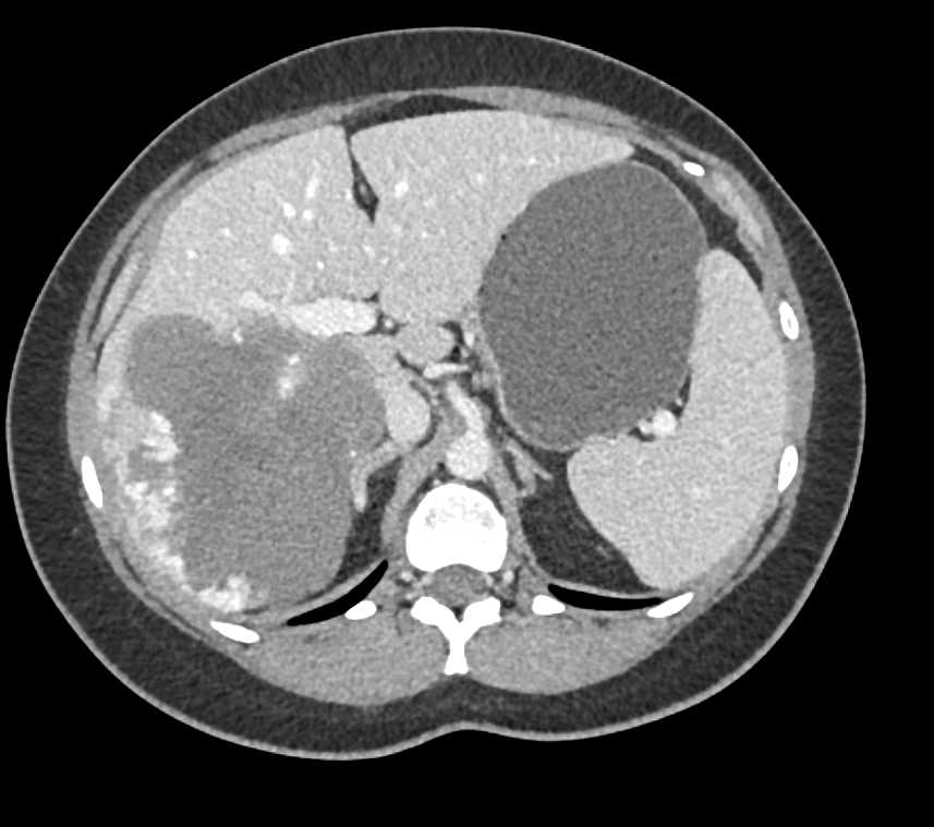 Hepatic Hemangioma - CTisus CT Scan