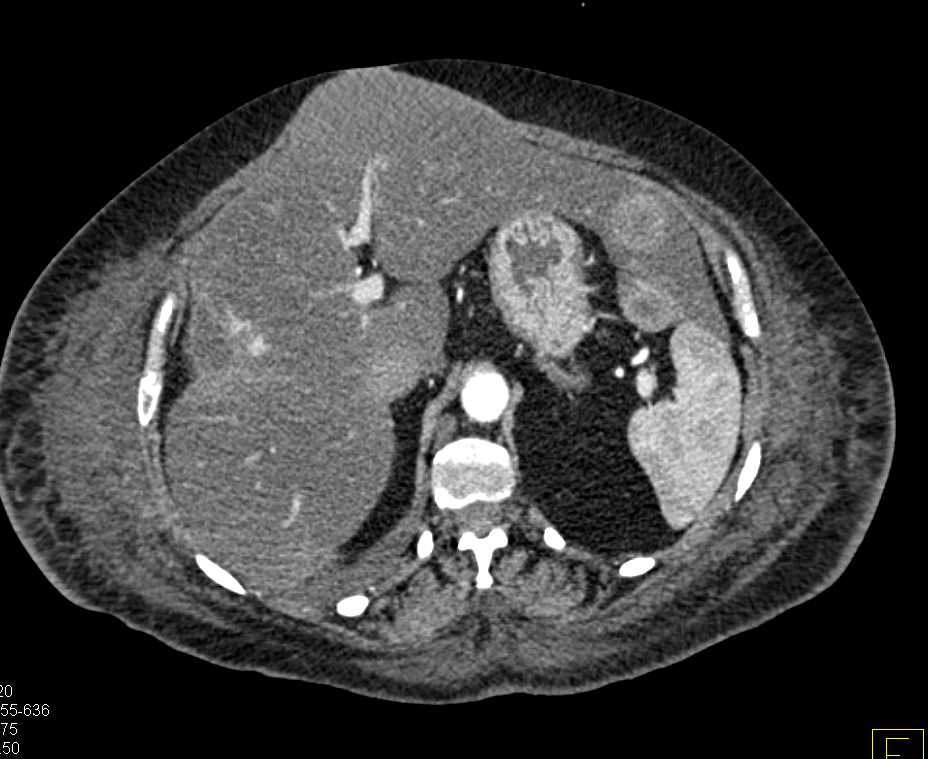 Metastatic Carcinoid Tumor to the Liver - CTisus CT Scan