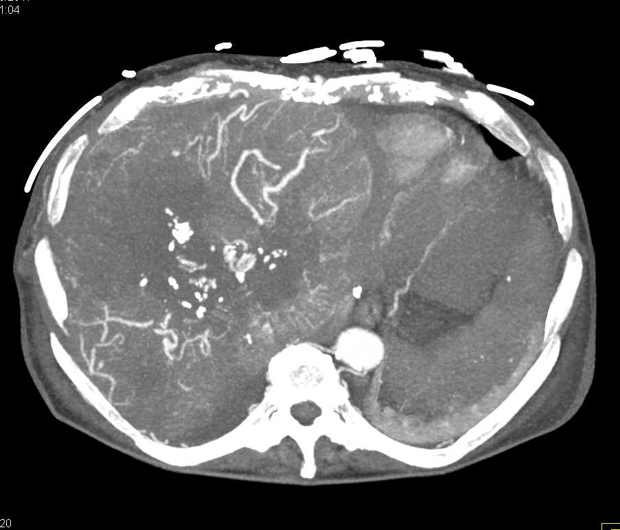 Angiosarcoma Liver - CTisus CT Scan