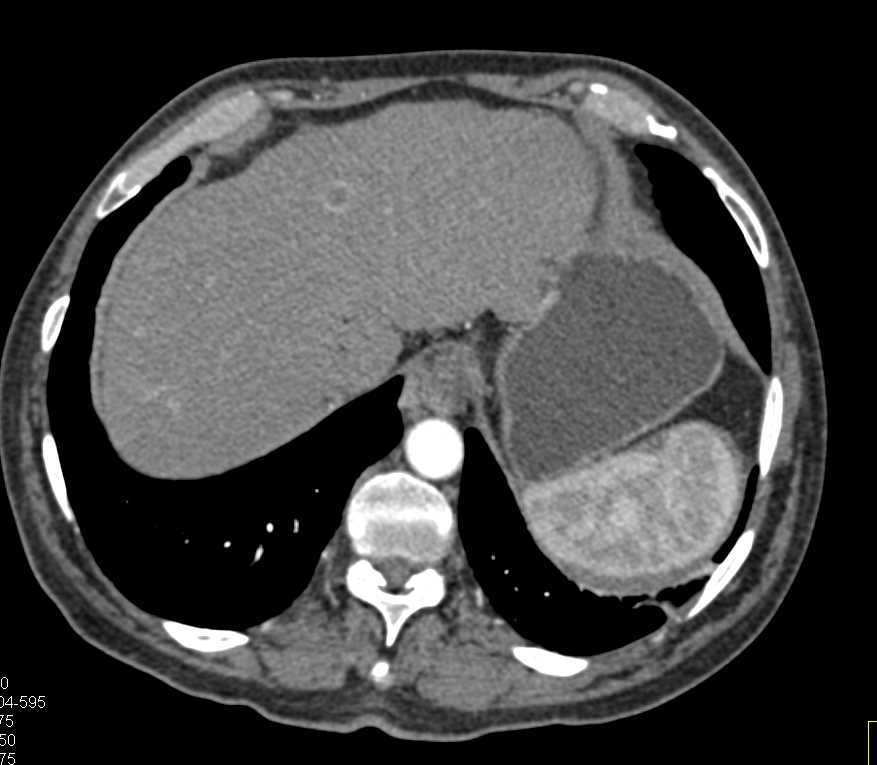 Subtle Liver Metastases - CTisus CT Scan