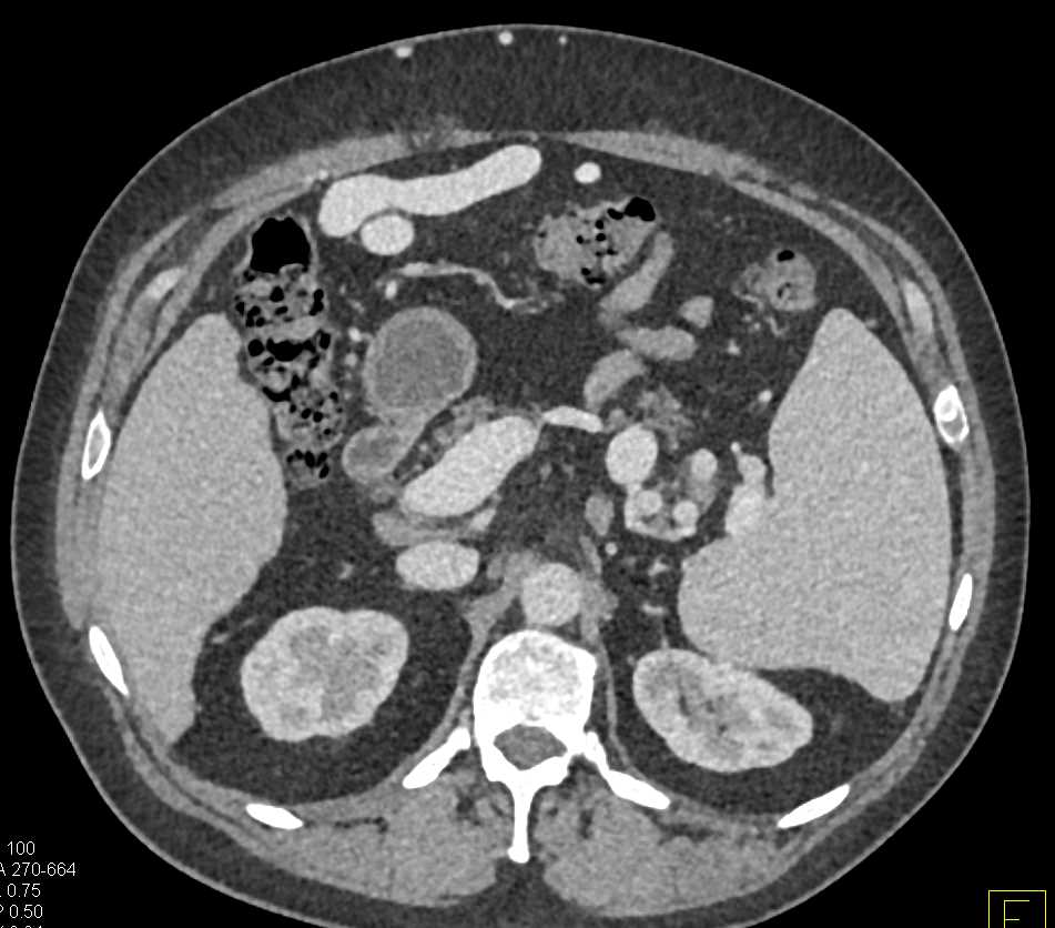 Cirrhosis with Large Varices - CTisus CT Scan