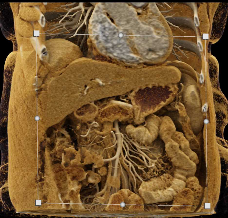 Stent in the Common Bile Duct with Cinematic Rendering - CTisus CT Scan