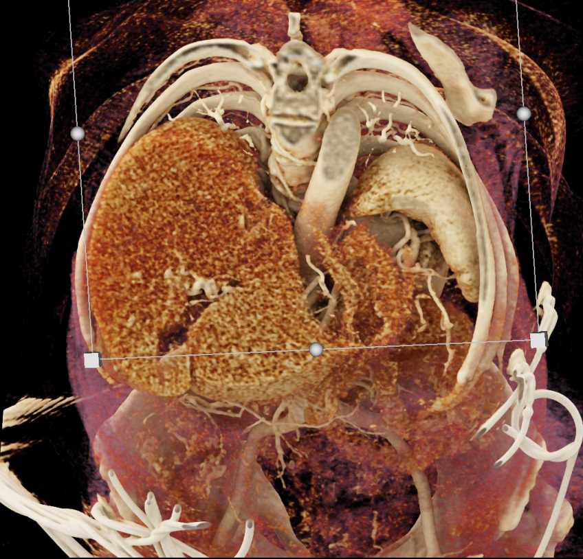 Textural Changes Dome of the Liver - CTisus CT Scan