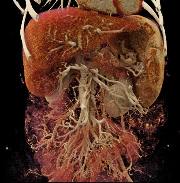 Patent Stent in the Main Portal Vein with Cinematic Rendering - CTisus CT Scan