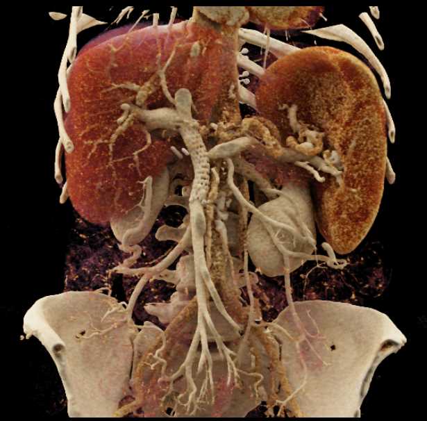 Patent Stent in the Main Portal Vein with Cinematic Rendering - CTisus CT Scan