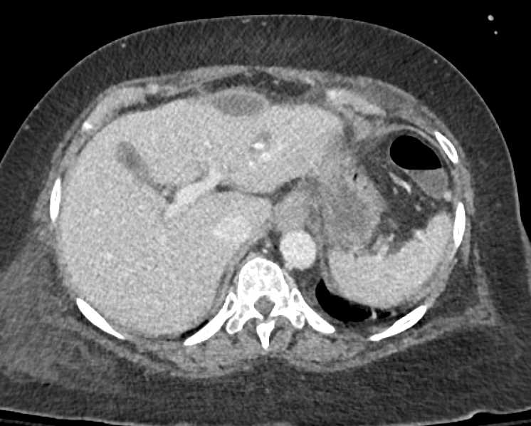 Subcapsular Collection Liver - CTisus CT Scan