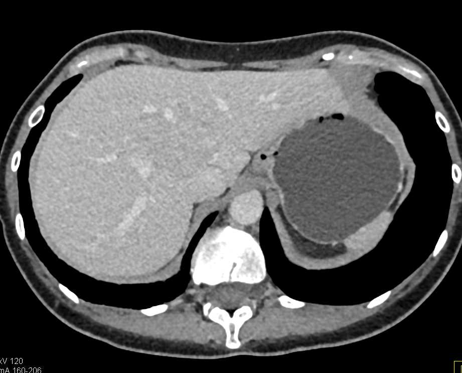 FNH Liver - CTisus CT Scan