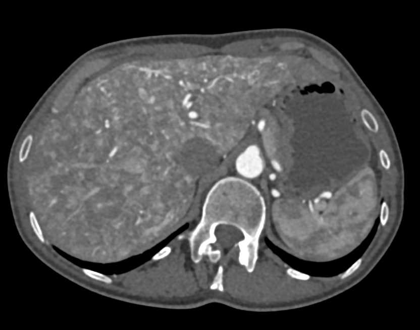 Multiple Arteriovenous Malformations (AVMs) in the Liver in a Patient with Hereditary Hemorrhagic Telangiectasia (HHT) Disease - CTisus CT Scan