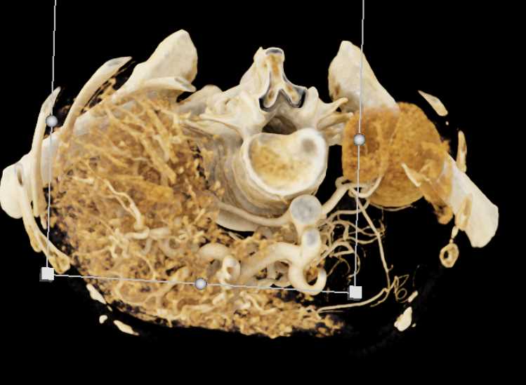 Multiple Arteriovenous Malformations (AVMs) in the Liver in a Patient with Hereditary Hemorrhagic Telangiectasia (HHT) Disease - CTisus CT Scan