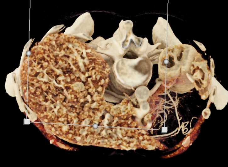 Multiple Arteriovenous Malformations (AVMs) in the Liver in a Patient with Hereditary Hemorrhagic Telangiectasia (HHT) Disease - CTisus CT Scan