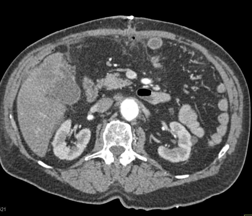 Gallbladder Cancer with Liver Metastases - CTisus CT Scan