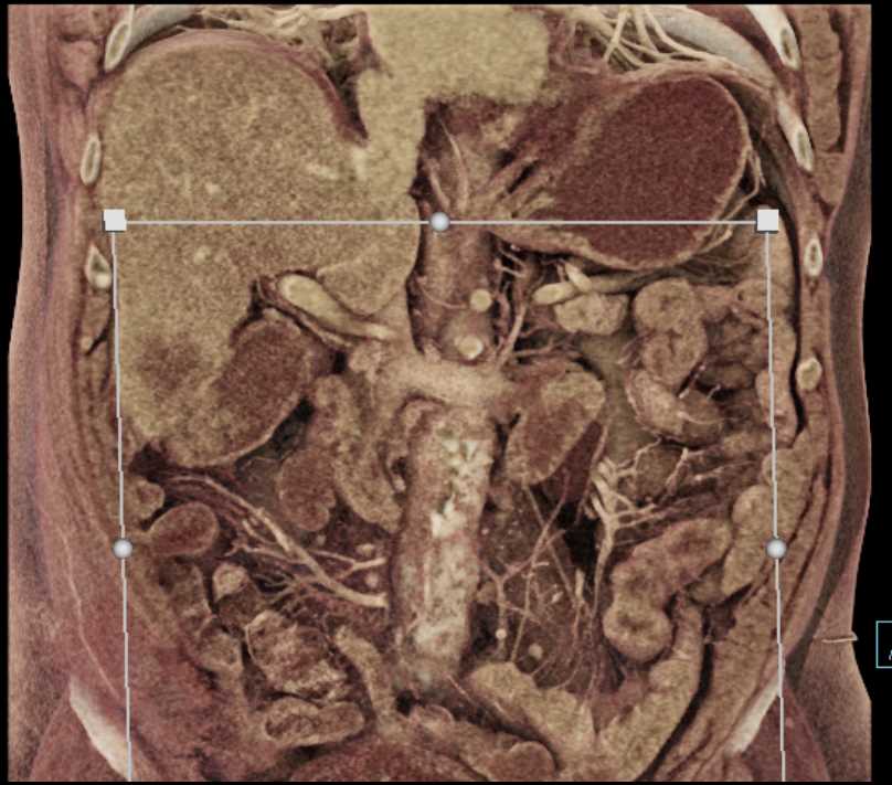 Gallbladder Cancer with Liver Metastases - CTisus CT Scan