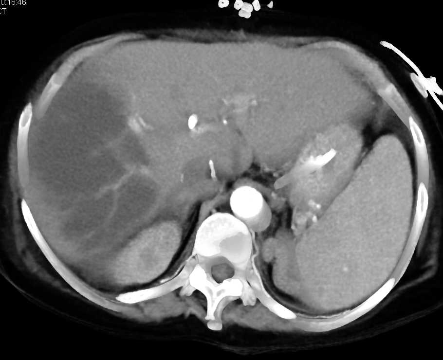 Liver Infarction - CTisus CT Scan