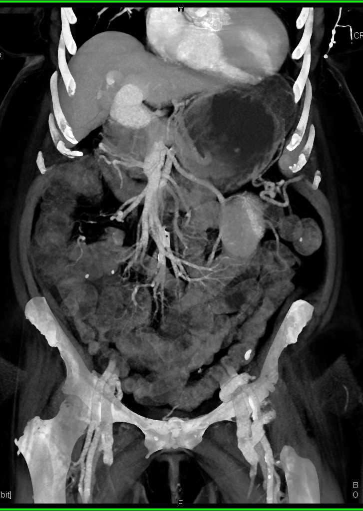 Cirrhosis with Huge Varices - CTisus CT Scan