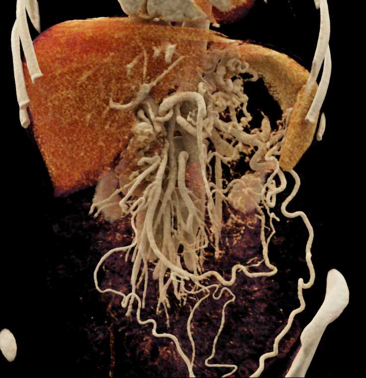 Portal Vein Occlusion with Collaterals - CTisus CT Scan