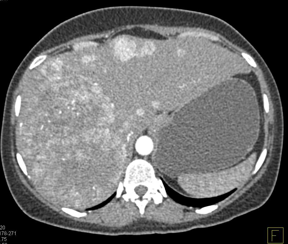 Multifocal Hepatoma with Neovascularity - CTisus CT Scan