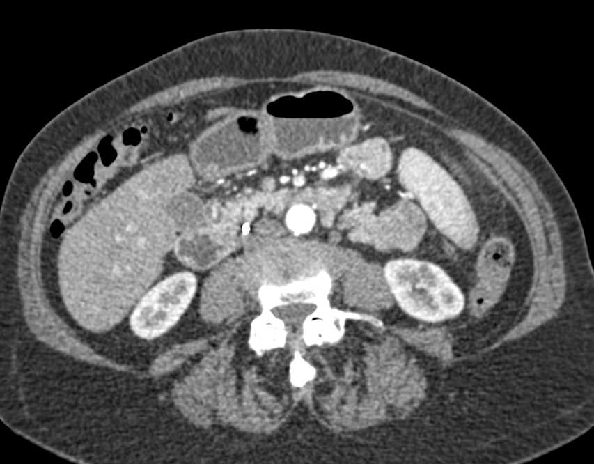 Gallstones and Early Gall Bladder Cancer - CTisus CT Scan