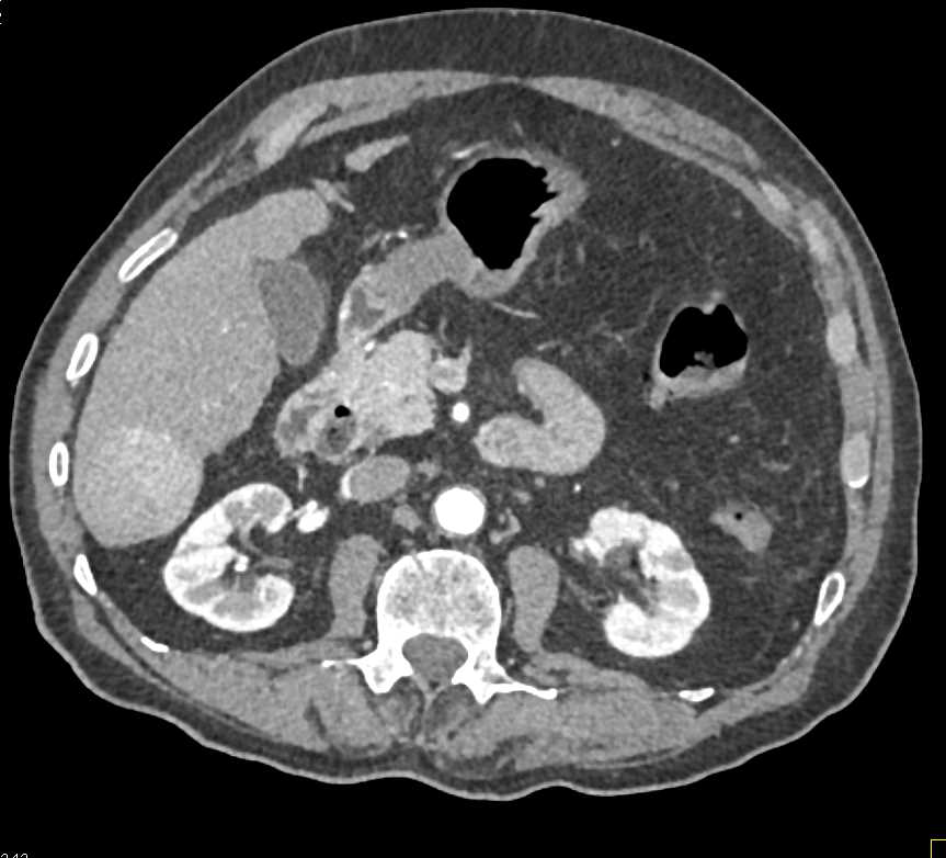 Focal Nodular Hyperplasia (FNH) - CTisus CT Scan