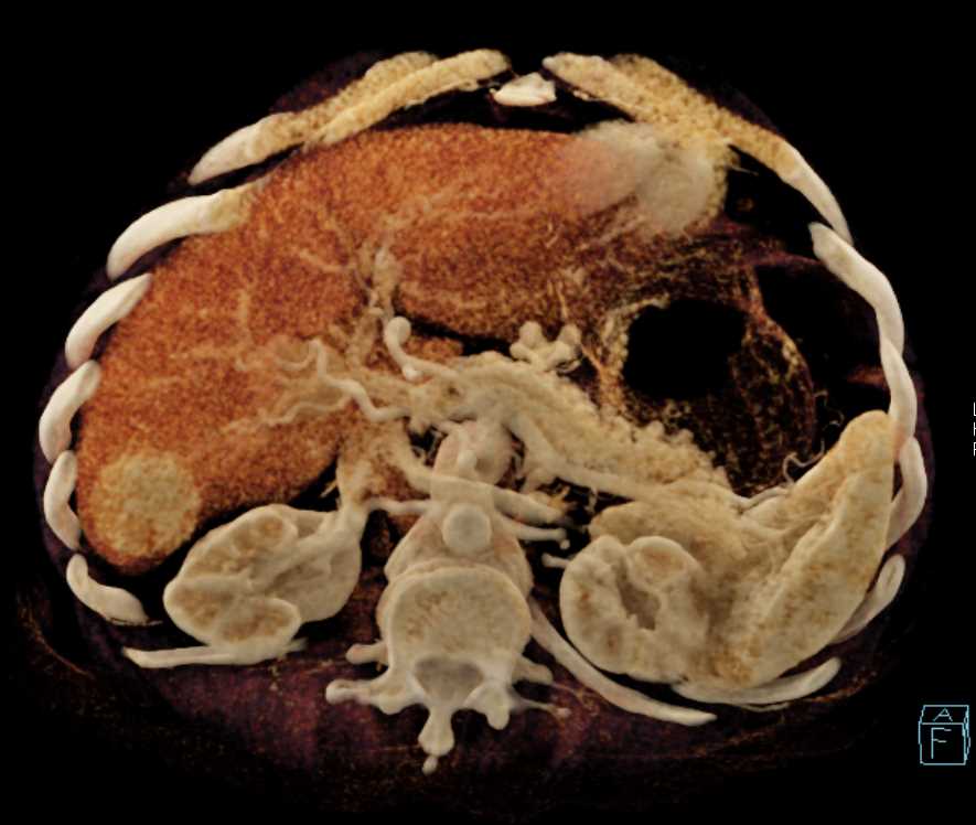 Focal Nodular Hyperplasia (FNH) - CTisus CT Scan