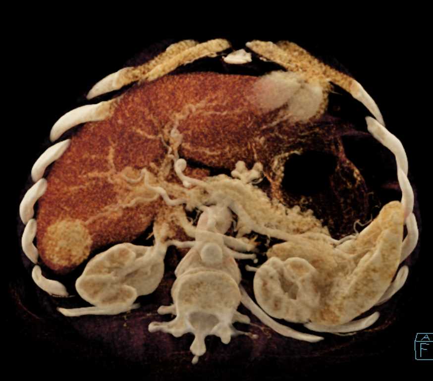 Focal Nodular Hyperplasia (FNH) - CTisus CT Scan