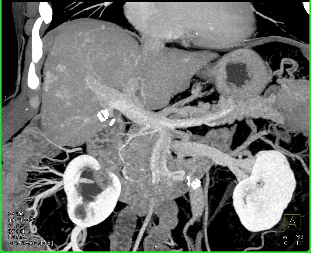 Multifocal Hepatoma in a Cirrhotic Liver - CTisus CT Scan