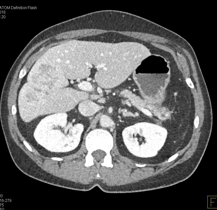 Hepatoma in Cirrhotic Liver - CTisus CT Scan