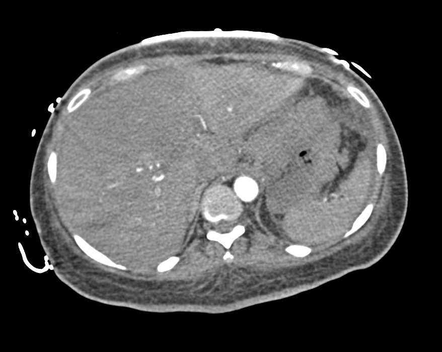 Multiphase Liver Metastases - CTisus CT Scan