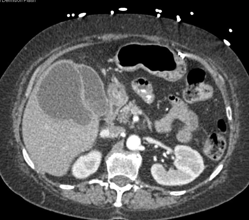 Infected Liver Cysts - CTisus CT Scan