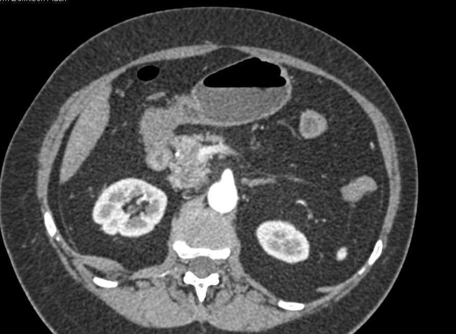 Multiple Stones in the Common Bile Duct - CTisus CT Scan