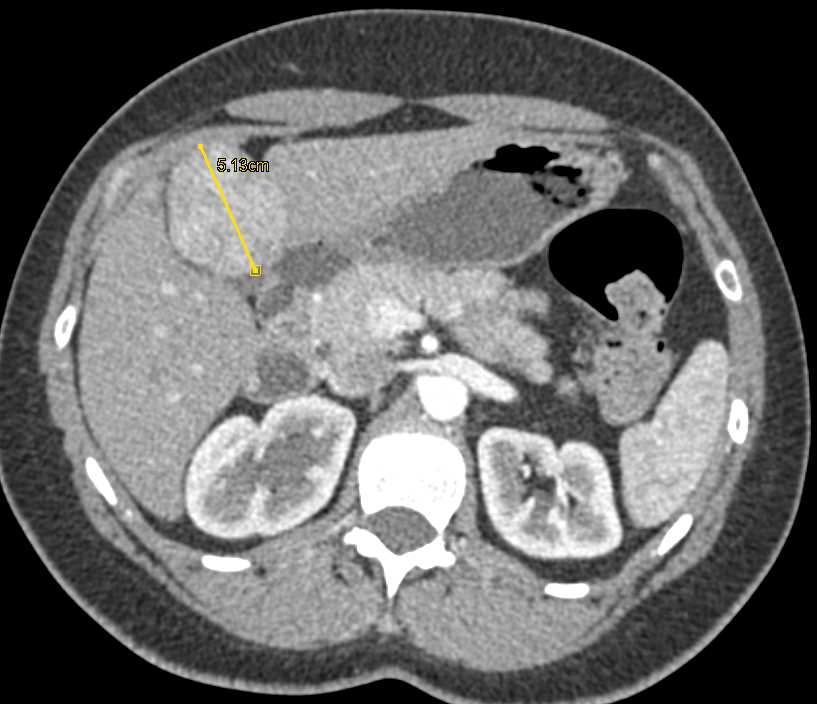 Hepatic Adenoma - CTisus CT Scan