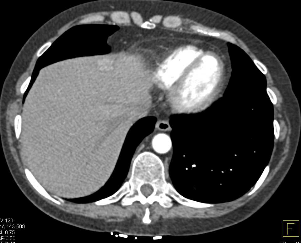 Hemangioma Left Lobe of Liver - CTisus CT Scan