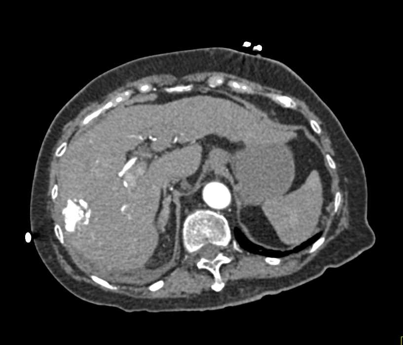 Active Bleed from the Right Lobe of the Liver - CTisus CT Scan