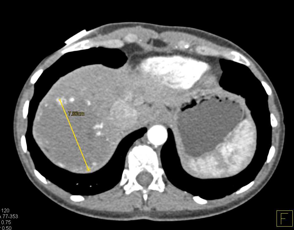 Hemangioma of the Liver with Classic Enhancement - CTisus CT Scan