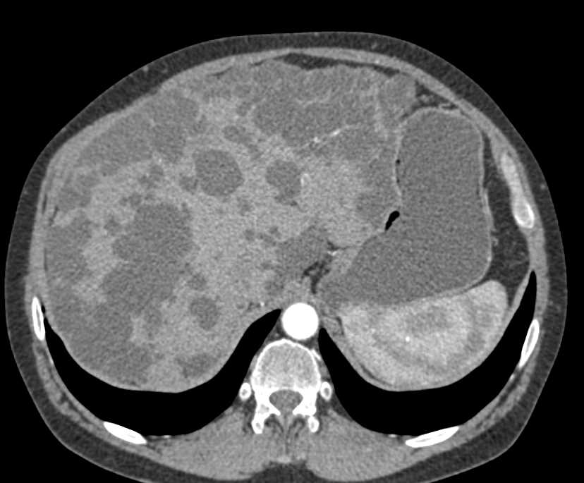 Polycystic Liver Disease and Transplant Kidney - CTisus CT Scan