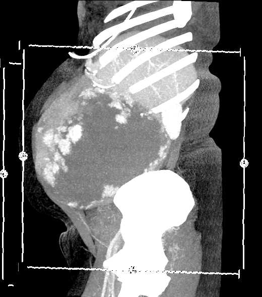 Giant Hepatic Hemangioma - CTisus CT Scan