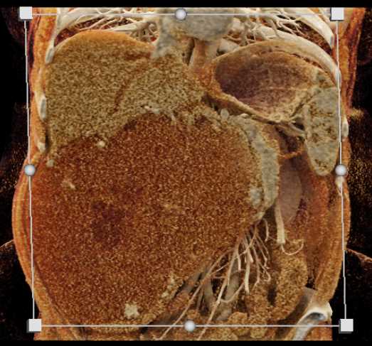 Giant Hepatic Hemangioma - CTisus CT Scan