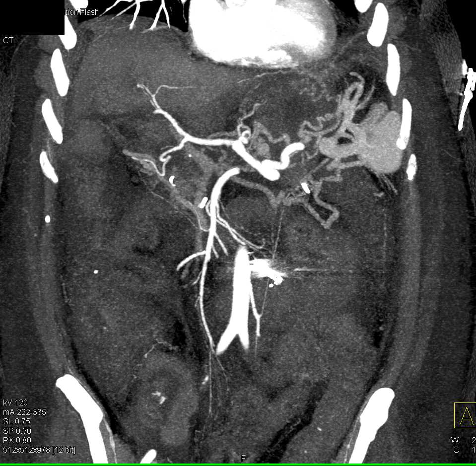 Cirrhosis with Varices - CTisus CT Scan