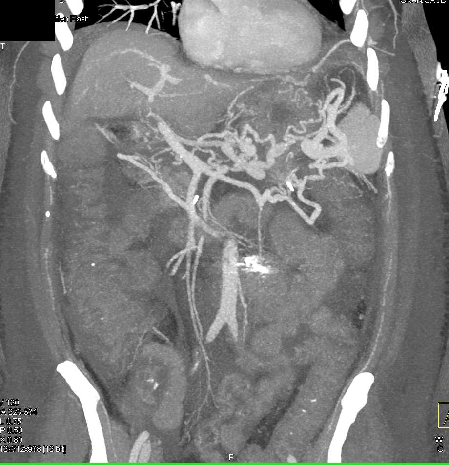 Cirrhosis with Varices - CTisus CT Scan