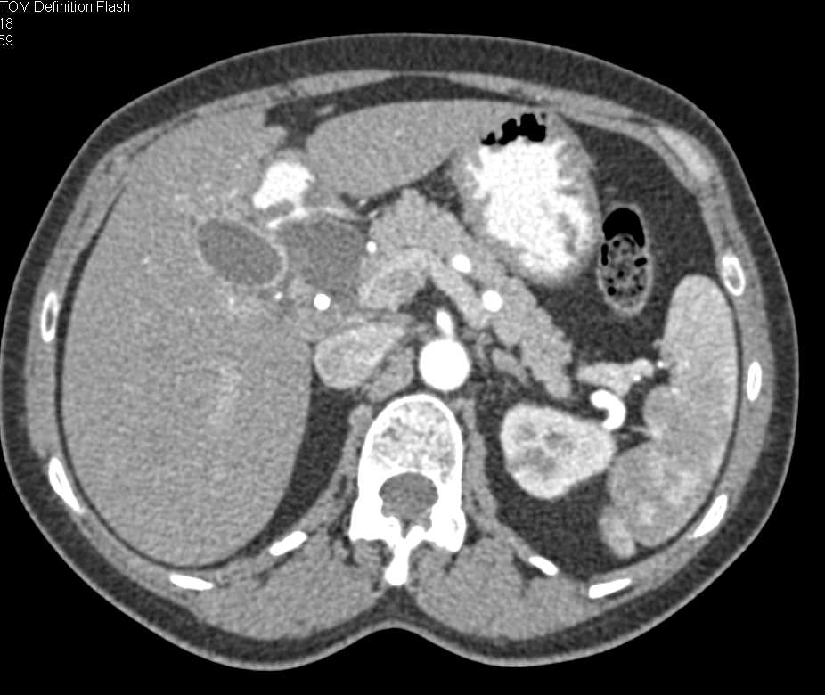Cystic Lesion Near CBD and Gallbladder - CTisus CT Scan