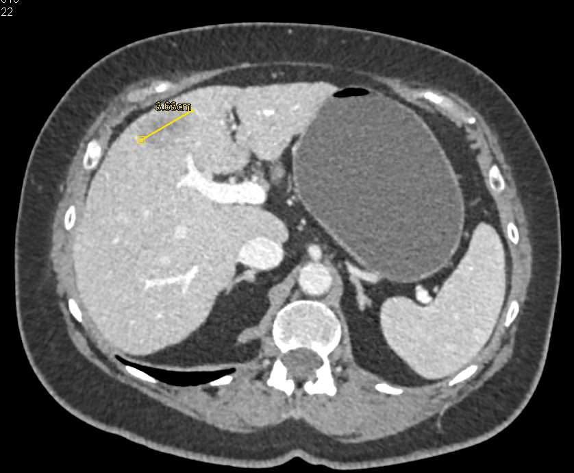 Liver Metastases from Gastric cancer - CTisus CT Scan