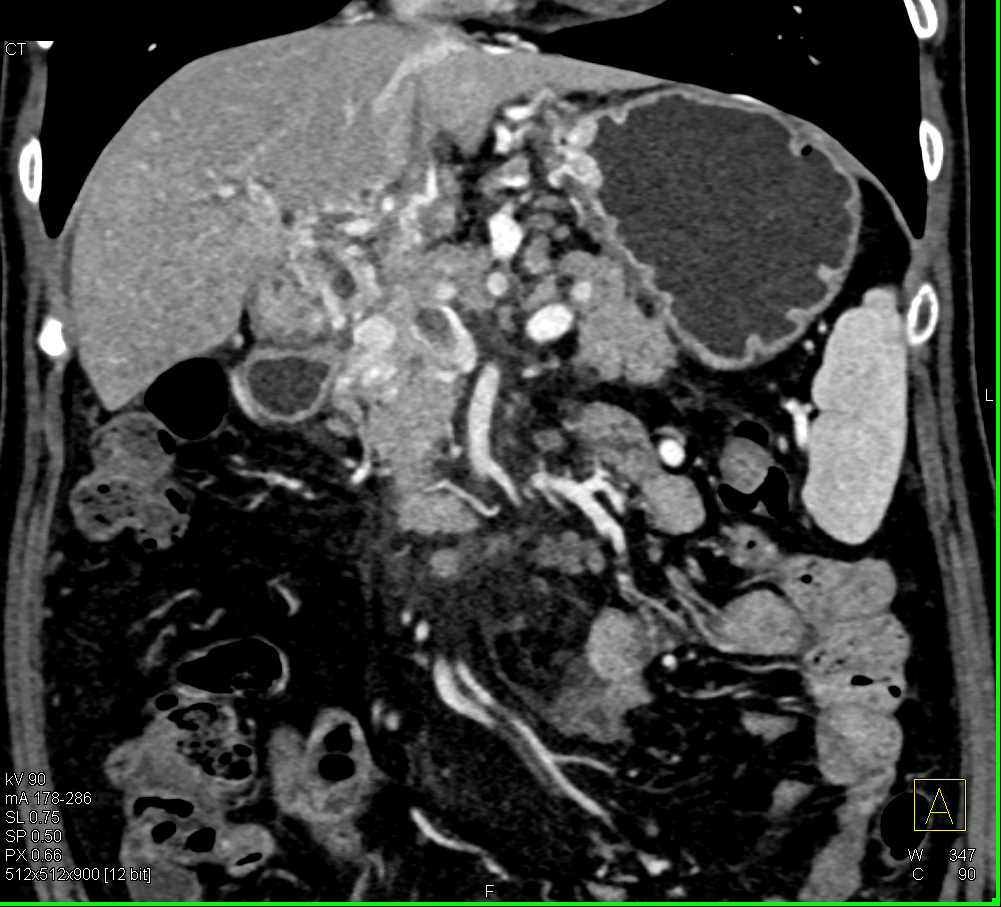 Cancer of the Common Bile Duct with Vascular Invasion - CTisus CT Scan